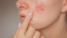 El Láser Colorante Pulsado, KTP, IPL, Láser Amarillo y la Terapia de Fluorescencia han demostrado su efectividad contra esta enfermedad dermatológica