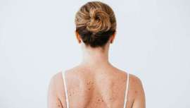 El sistema de dermatoscopia digitalizada, conocer el ABCDE de los lunares y visitar regularmente al dermatólogo se convierten en los mejores aliados para prevenir el melanoma, según la doctora Marta González