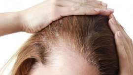 La mesoterapia capilar es un tratamiento médico que consiste en microinyecciones de vitaminas, minerales, aminoácidos y otros nutrientes en el cuero cabelludo para estimular el crecimiento del cabello y mejorar su salud de la piel de la zona