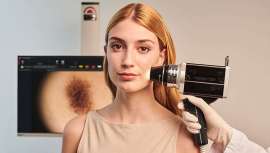 Al 54% de los españoles les preocupa padecer cáncer de piel,
pero solo el 10% revisa sus lunares anualmente