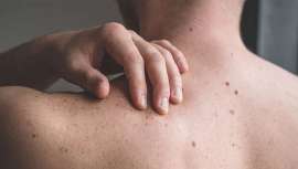 En el marco del Día Mundial contra el Cáncer de Piel, celebrado el 13 de junio, el Congreso Novedades en Dermatología ha lanzado una preocupante advertencia: para 2030, un 20% de la población estará en alto riesgo de desarrollar cáncer de piel