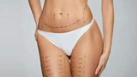 El informe presentado durante el Congreso Mundial de ISAPS reveló que la liposucción lideró entre las cirugías más populares, mientras que la toxina botulínica destacó entre los procedimientos no quirúrgicos más demandados