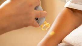 Según el Instituto Médico Láser, los tratamientos con láser que se pueden realizar en verano abarcan una amplia variedad de afecciones dermatológicas como lesiones pigmentadas como léntigos y melasmas o lesiones vasculares