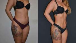 Analizamos dos procedimientos estéticos, la abdominoplastia y la lipoescultura, según la perspectiva del Dr. Ahmad Saad, destacando las indicaciones y beneficios de cada uno