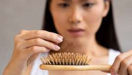La alopecia androgénica, el tipo más común de caída del cabello, está influenciada por factores genéticos y hormonales, pero también puede ser exacerbada por el sedentarismo y un estilo de vida poco saludable