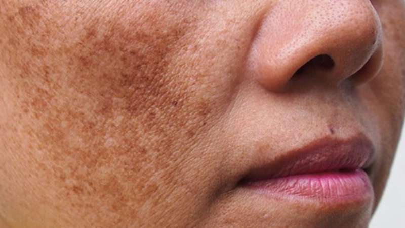 Mesoterapia con �cido tranex�mico: la soluci�n para tratar el melasma en verano