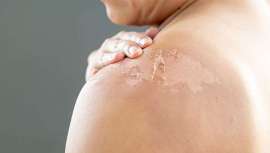 Después de días de sol intenso, la piel puede comenzar a pelarse, un proceso natural pero incómodo. Descubre cómo cuidar tu piel y mantenerla saludable mientras se renueva