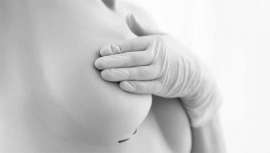 La mamoplastia avanza con la técnica AMI, que reduce cicatrices y acelera la recuperación. Este crecimiento refleja el creciente interés por la cirugía estética en España