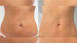 Es el primer centro de Barcelona que dispone de este equipo, capaz de rejuvenecer y mejorar el aspecto de la piel -facial y corporal- en tan solo una sesión