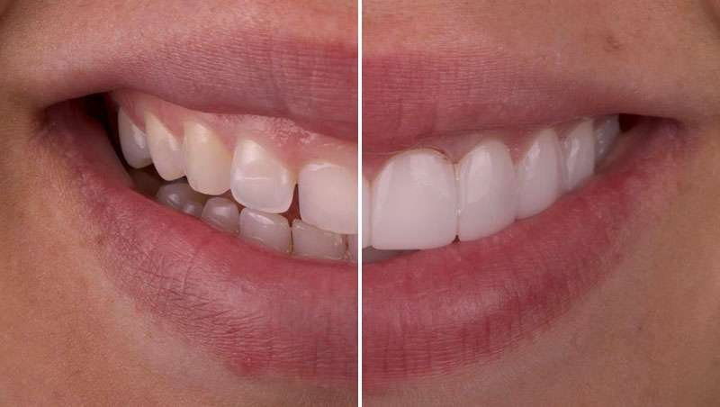 Blanqueamiento o carillas sin tallado, qu es mejor para unos dientes blancos?