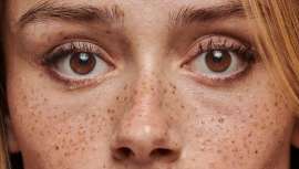 La piel fatigada resulta del estrés y la falta de sueño. La Dra. Penalba propone combatirla con tecnología médico-estética avanzada