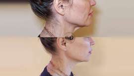 EVO Beauty Clinics presenta este tratamiento diseñado para pacientes que desean un lifting facial o una remodelación corporal sin pasar por quirófano