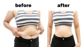 Representa el 18,8% de todas las intervenciones quirúrgicas, seguida del aumento de pecho, la blefaroplastia, la rinoplastia y la abdominoplastia