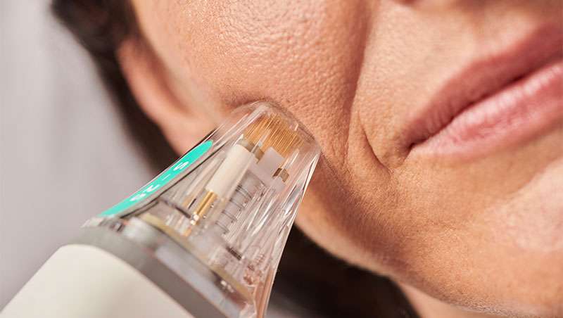 Toxina botul�nica vs estimuladores de col�geno: cu�ndo elegir uno frente al otro