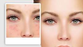 IN+be-UTY abordará en Beauty Contact Málaga las claves para tratar el acné y la rosácea con un enfoque innovador y multidisciplinar. No te lo pierdas, 23 y 24 de noviembre en el Parador de Málaga Golf