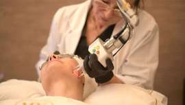 Maribel Yébenes presenta esta modalidad del Láser CO2 Ultrapulsado Híbrido, único en el mercado que permite una recuperación más rápida y puede hacerse todo el año