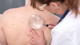 Más del 80% de los casos de melanoma cutáneo en el mundo están relacionados con la radiación ultravioleta, según un nuevo estudio de la OMS. La enfermedad, aunque prevenible, sigue en aumento especialmente entre las poblaciones de piel clara