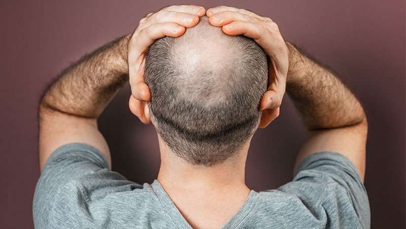 Espaa es el pas con ms calvos del mundo