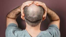 Es oficial. El 80% de los hombres en España sufrirá caída capilar en algún momento de su vida y ya estamos a la cabeza de calvos a nivel mundial