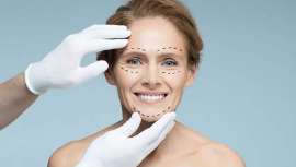 El aumento de consultas impulsa el interés por técnicas quirúrgicas que ofrecen resultados naturales, como el deep plane, la cirugía de Kris Jenner