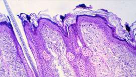 Se denomina así a la etapa de transición entre la caída y la recuperación del cabello después de un tratamiento anticaída. Parece que se está perdiendo más pelo, pero en realidad volverán a crecer nuevos cabellos y con más fuerza