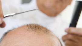 La finasterida es un principio activo y el que mejores resultados está obteniendo contra la alopecia. Se emplea básicamente para dos tratamientos: el tratamiento de la hiperplasia benigna de próstata y la alopecia andogénica