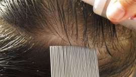 El piojo, como huésped desagradable de la cabeza, es un parásito que toca muy de cerca al profesional de la peluquería. A veces, indirectamente y, desgraciadamente, a veces de forma muy directa