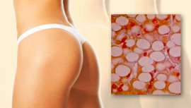 El lipoláser permite remodelar la silueta, reducir la celulitis y atenuar la flacidez, con la posibilidad de tratar acúmulos grasos pequeños en zonas donde la liposucción tradicional no puede actuar