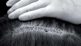 Esta técnica de trasplante capilar, mínimamente invasiva, está considerada como la más avanzada que existe