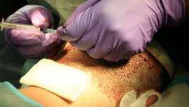 Esta novedosa técnica se realiza con el objetivo de repoblar el nacimiento del cabello, consiguiendo que el vello pueda crecer hasta los dos centímetros, y aunque no alcanza el tamaño de un cabello normal, sí consigue un aspecto general más natural