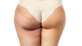 Se trata de un mal que afecta al 90% de las mujeres, obesas o no. Una buena alimentación, ejercicio y prevención se convierten en nuestra mejor arma para luchar contra la temida piel de naranja