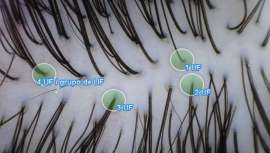 El profesional de la peluquería conoce la salud del cabello y el historial capilar de su cliente. Pocos como ellos para aconsejar cuáles pueden ser los mejores sistemas de conservación y cuidado del cabello o, en su defecto, una intervención capilar