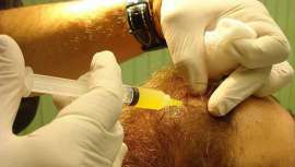 En el plasma que se extrae de la sangre del propio paciente puede estar la solución a uno de los problemas estéticos que sufre una gran parte de los hombres: la caída del cabello