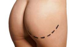 Es la cirugía plástica estética que se especializa en el aumento de glúteos. Es similar a una operación de aumento de mamas, pero en la zona posterior del cuerpo