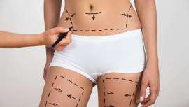 Uno de los mayores avances de la cirugía plástica moderna sigue tan en auge como siempre, permitiendo a mujeres y hombres de todo el mundo el deshacerse de los cúmulos de grasa localizados que no desaparecen ni con ejercicio ni con dieta