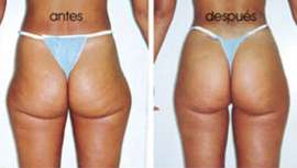 Con el equipo Meso-Vac Injector System y las fórmulas de Lamdors, se activan las funciones del cuerpo para una eliminación de la grasa más efectiva