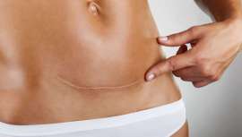 La época estival puede resultar crítica en el período de cicatrización de una herida, y cualquier paso en falso en su tratamiento puede provocar una marca de por vida