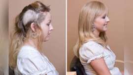 También llamada tricotilosis, es una enfermadad que padece una pequeña parte de la población y está caracterizada por un desorden compulsivo por el que se siente la necesidad de arrancarse el cabello, ya sean cejas, vellos o el de la cabeza