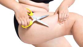 Se trata de la operación de cirugía estética más demandada por los españoles. Ninguna otra técnica de reducción de grasa la supera en resultados y garantías para los pacientes