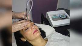 Una técnica ideal para que la piel se renueve naturalmente ayudando a disminuir cicatrices y reducir arrugas