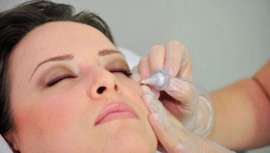 Este tratamiento antiojeras compagina carboxiterapia local y Volbella, un ácido hialurónico reticulado de bajo poder hidrofílico. Los resultados son muy naturales y visibles a partir de la primera sesión 