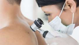 El próximo 13 de junio se celebra el Día Europeo de la Prevención del Cáncer de Piel, con el objetivo de concienciar a la población sobre esta problemática que se ha incrementado en los últimos años 