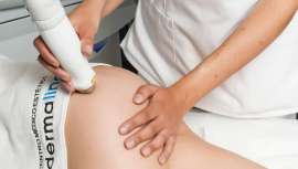 Entre el 50 y el 90% de la población mundial padece estrías, según las últimas publicaciones científicas. Hasta ahora, solo se suavizaban. Hoy en día, gracias a un nuevo protocolo a base de láser, junto con otros procedimientos, pueden desaparecer 