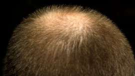 Dicen que la naturaleza es sabia. De ser así, un sistema inmunitario fuerte actúa como un crecepelo eficaz. Así lo aseguran investigadores del Centro Nacional de Investigaciones Oncológicas (CNIO)