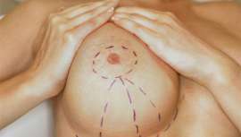 El cirujano plástico Rubén García-Guilarte explica la función del sujetador y las causas del incremento de estas intervenciones