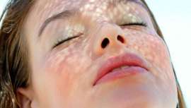 Los problemas de pigmentación debidos al sol pueden eliminarse con técnicas menos agresivas que los producidos por problemas hormonales