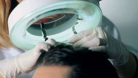 Por iniciativa de Svenson, el estudio tiene por título Efectos Secundarios de Minoxidil ± Finasterida