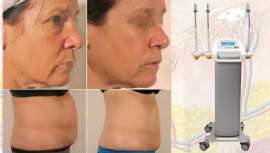 Es un equipo médico-estético avanzado que nos permite tratar las cuatro capas de la piel para un tratamiento completo antienvejecimiento y resultados evidentes en contorno corporal