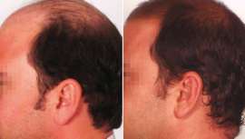 En cuestioón de caída capilar, no todo vale. El folículo que muere, no resucita. Indiba Deep Beauty es el único método natural y no invasivo que aporta resultados en los casos de caída de cabello no cicatricial o reversible 