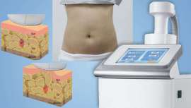 Grupo Slyou lanza al mercado una solución para contornear el cuerpo, basado en una pionera tecnología centrada en el ultrasonido focalizado HIFU junto con terapia de succión